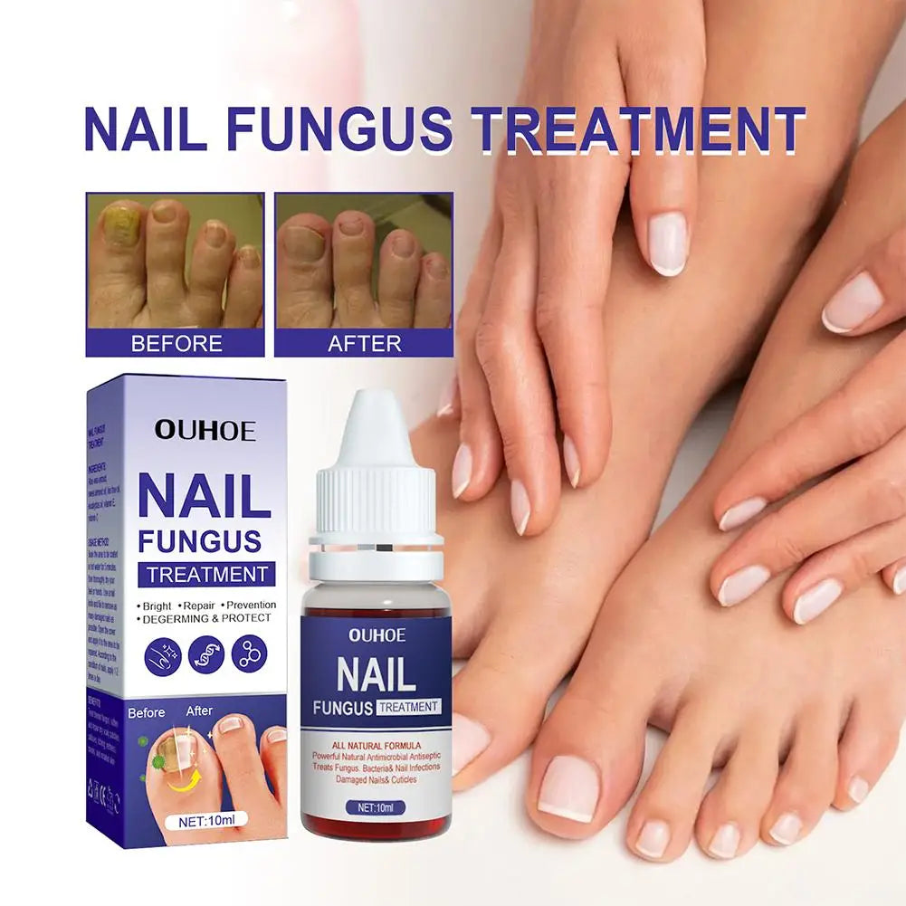 1PCS Nail Fungal Treatment Feet Care Essence Anti Infection Onychomycosis Paronychia Fungus Toe Removal Serum Fungal Nail R V5V8