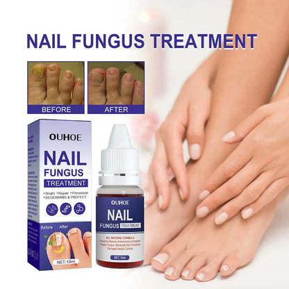 1PCS Nail Fungal Treatment Feet Care Essence Anti Infection Onychomycosis Paronychia Fungus Toe Removal Serum Fungal Nail R V5V8